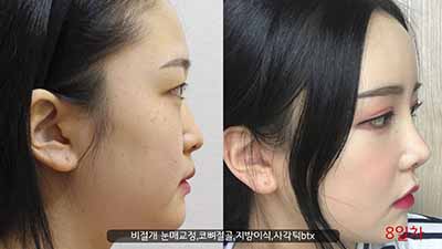 韩国艾恩整形外科眼鼻整形官网案例