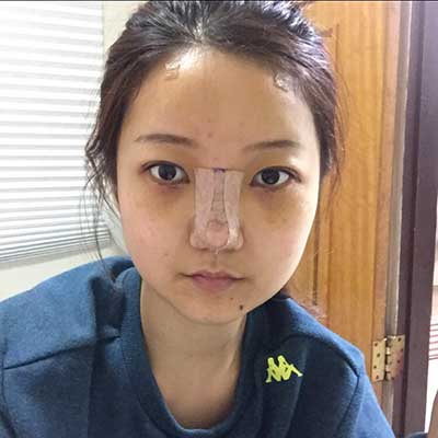 韩国艾恩整形医院隆鼻术后恢复照片