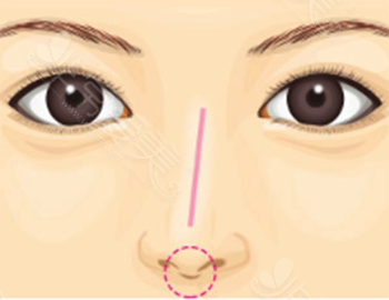 隆鼻术后歪斜如何修复 朱诺整形全面解析修复方法及优缺点