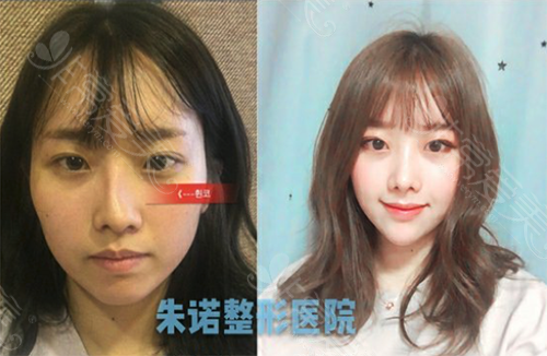 韩国朱诺整形外科鼻修复手术