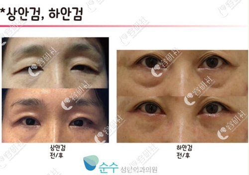 韩国纯真整形外科眼底脂肪重排案例