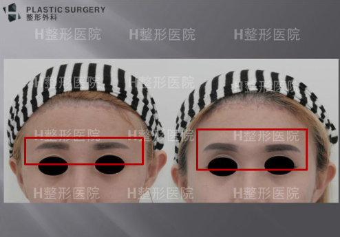 韩国H整形眉弓垫高手术对比