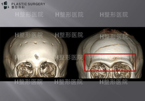 韩国白汀恒额头垫高手术CT