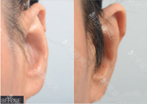 常见耳朵整形方式几种？改善案例和手术价格这篇全有！