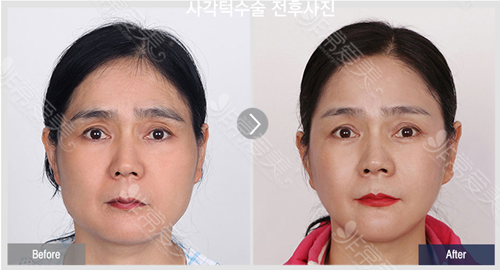 韩国菲斯莱茵整形医院下颌角手术对比