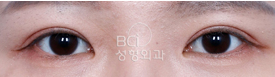 韩国BCI整形外科双眼皮图