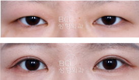 韩国BCI整形外科双眼皮怎么样