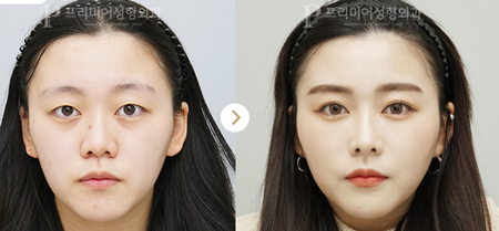 韩国普瑞美医院双眼皮展示图