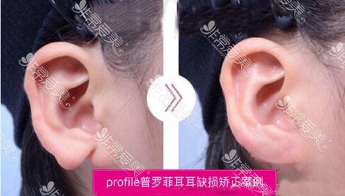 耳朵整形危险吗？常见的术后并发症有哪些，恢复疗效怎样