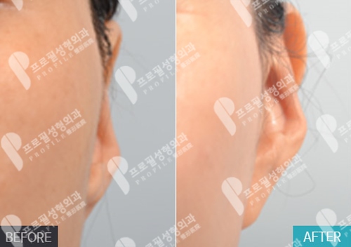 耳朵整形危险吗？常见的术后并发症有哪些，恢复疗效怎样