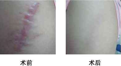 韩国童颜中心激光治疗疤痕对比图