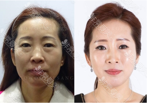  韩国德丽珍整形外科面部提升