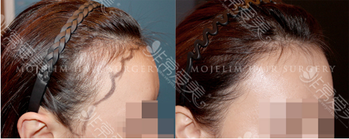 韩国毛杰琳整形外科毛发移植