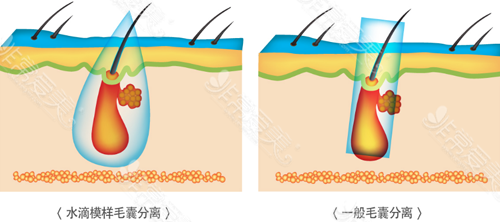 水滴形毛囊分离技术与一般毛囊分离技术对比