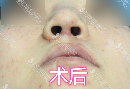 韩国美所有整形医院唇腭裂手术二次手术术后对比 韩国美所有整形医院唇腭裂手术二次手术术后对比