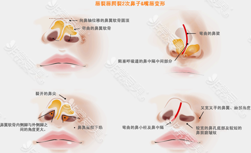 韩国美所有整形医院唇腭裂手术二次手术图解
