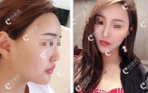 韩国歌柔飞整形外科鼻修复案例