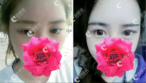 韩国秀美颜整形外科眼修复案例