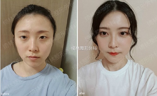 韩国绮林Girin整形外科开眼角和不开的区别图