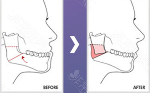 下颚整形手术要多少时间，常见的方式有几种优势是什么？