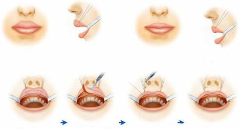 厚唇改薄手术常见方法图解