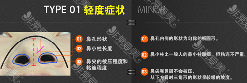 双侧侧性轻微唇裂对鼻孔的影响 双侧侧性轻微唇裂对鼻孔的影响