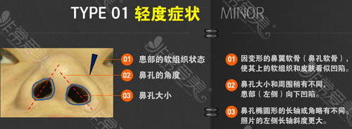 单侧性轻微唇裂对鼻孔的影响 单侧性轻微唇裂对鼻孔的影响