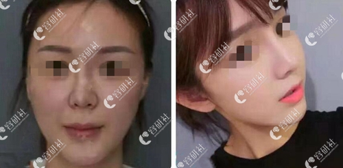 北京米扬丽格医疗美容巫文云鼻修复案例