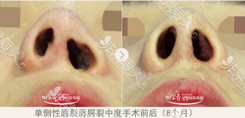 唇裂鼻畸形修复方式分享，一边高一边低也能进行修复？