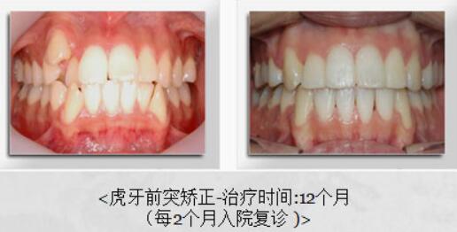 韩国多仁牙科牙齿矫正案例图