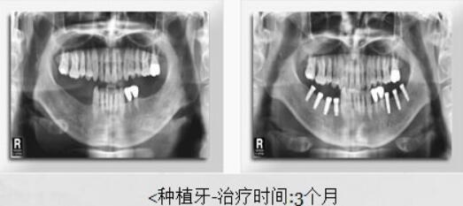 韩国多仁牙科种植牙治疗案例