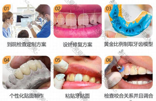 牙齿贴面手术过程示意