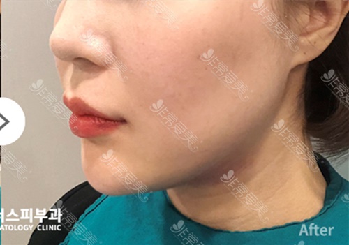 韩国DOCTORS皮肤科双下巴松弛整形案例图