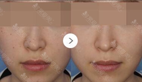 韩国doctors皮肤科怎么去除脸上色素沉着