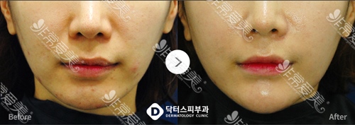韩国DOCTORS皮肤科玻尿酸填充下巴图片韩国DOCTORS皮肤科玻尿酸填充下巴图片