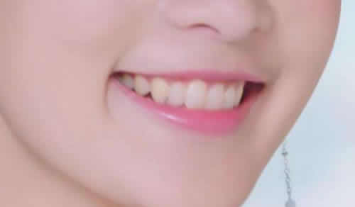 牙齿美白贴片好不好？为什么韩国明星都会做牙贴片？
