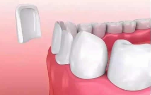牙齿美白贴片过程讲解