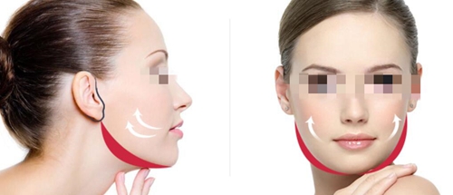 小切口提升可以使松弛的面部得到有效提升，切口隐蔽、损伤小、恢复快！