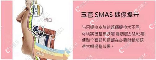 玉芭整形外科医院SMAS迷你提升和普通提升术的区别