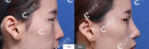 韩国女神整形外科鼻修复案例