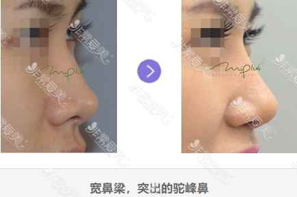 韩国美Plus整形外科鼻整形真人案例