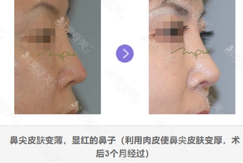 韩国美Plus整形外科鼻整形图片前后对比