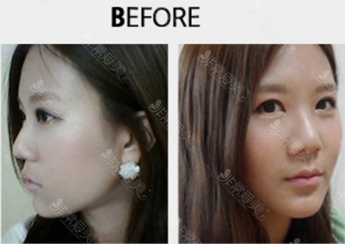 韩国美Plus整形外科隆鼻手术术前图