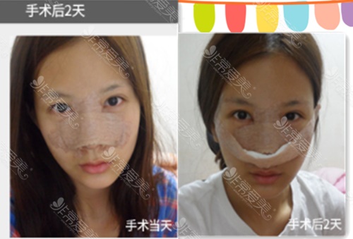 韩国美Plus整形外科鼻综合术后1-7天的照片