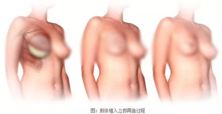 胸部再造方法有哪些，韩国胸部再造技术怎么样？