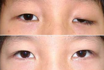 韩国bio整形外科双眼皮修复