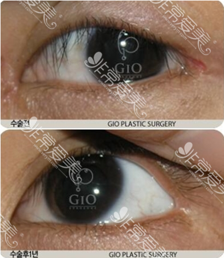 韩国GIO整形外科双眼皮修复