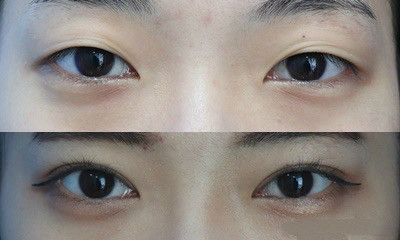 韩国纯真整形外科双眼皮修复