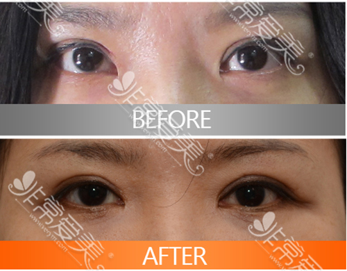 韩国EVE整形外科双眼皮修复