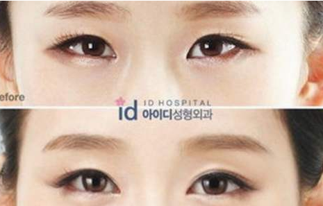 韩国ID整形医院双眼皮